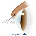 ciglia ectopica